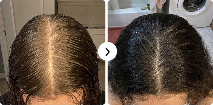 Ricrescita dei capelli prima e dopo